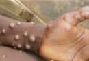 Togo: premiers cas de Mpox détectés à Lomé, les autorités sanitaires en alerte